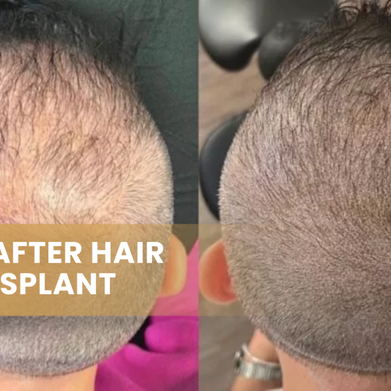 SMP After Hair Transplant