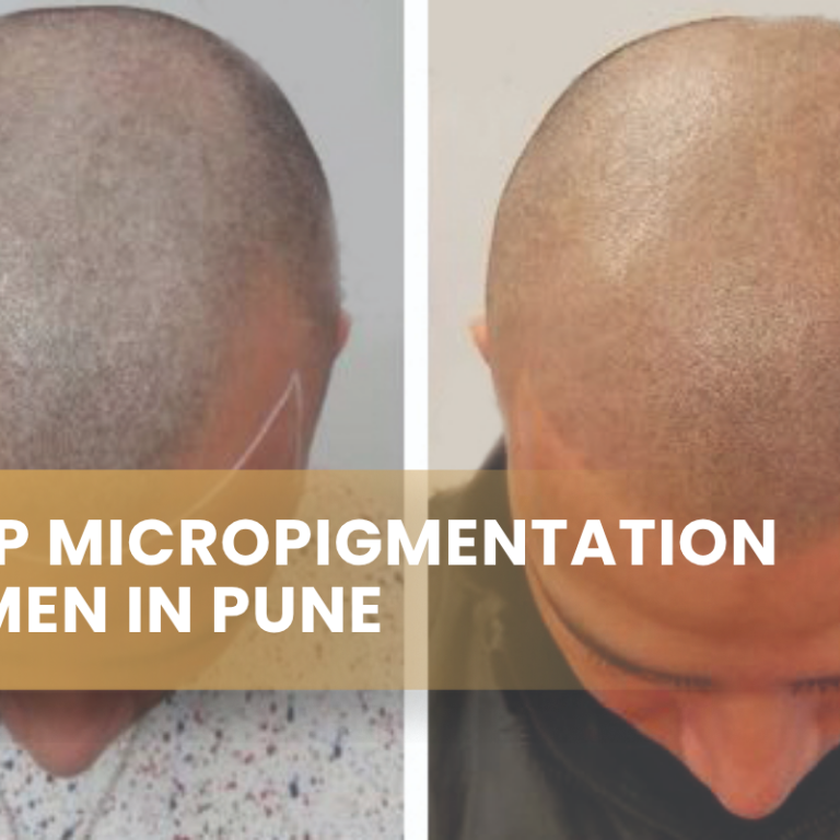 Scalp Micropigmentation for Men in Pune