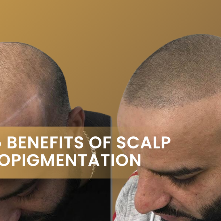Top 5 Benefits of Scalp Micropigmentation