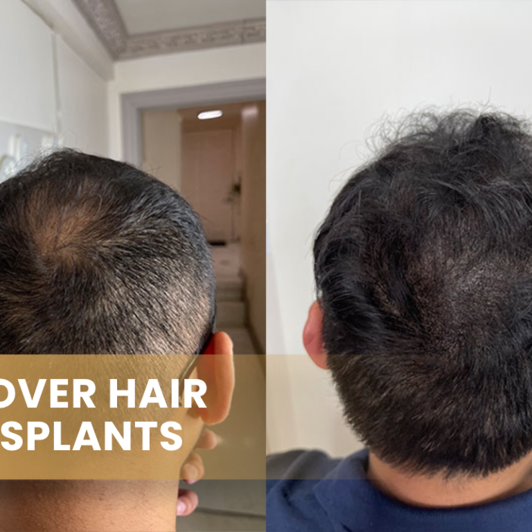 smp Over Hair Transplants