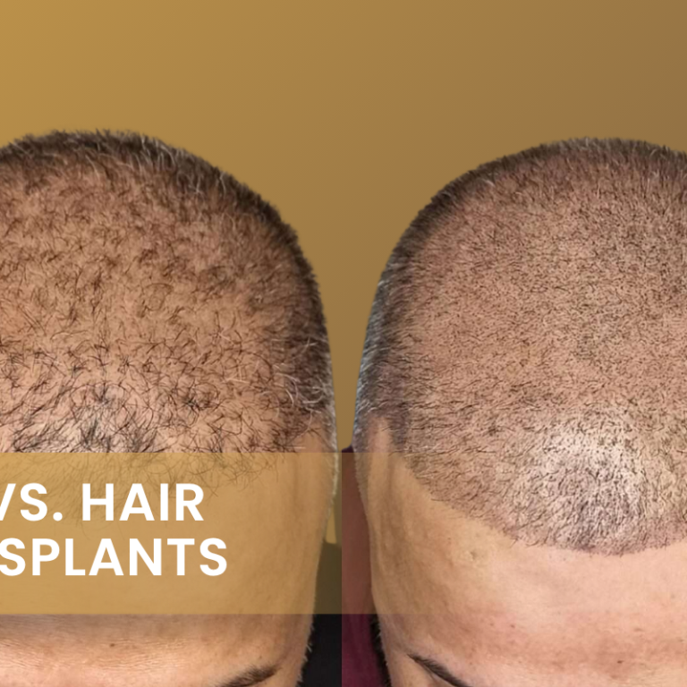 smp vs. Hair Transplants